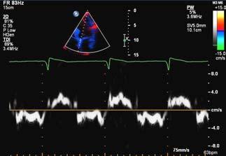 longitudinal strain, TD mitral annulus s velocity and MAPSE