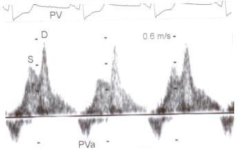 Deceleration Time of Pulmonary Venous Diastolic Velocity and LVFPs Measurement of the initial deceleration slope time BUT, - With faster