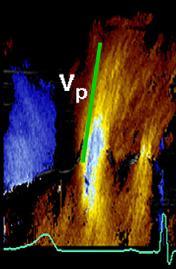 Intraventricular Colour M-mode Flow Propagation Velocity in Early