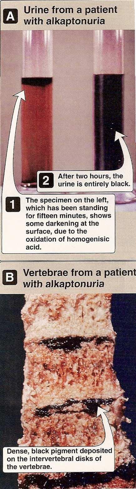 Alcaptonuria deficiency of homogentisate oxygenase homogentisic acid eliminated in urine darkening of urine owing to
