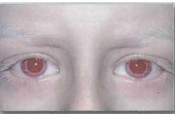 inflamations (from intracellular crystalization of tyrosine), mental Retardation Albinism - lack of melanin (brown