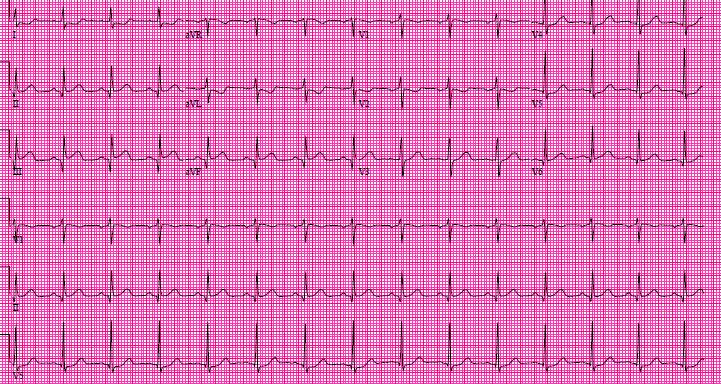 Case #2 73 year old male No past medical history Awoke with chest pain and diaphoresis Progressed, included nausea and emesis Presented to local
