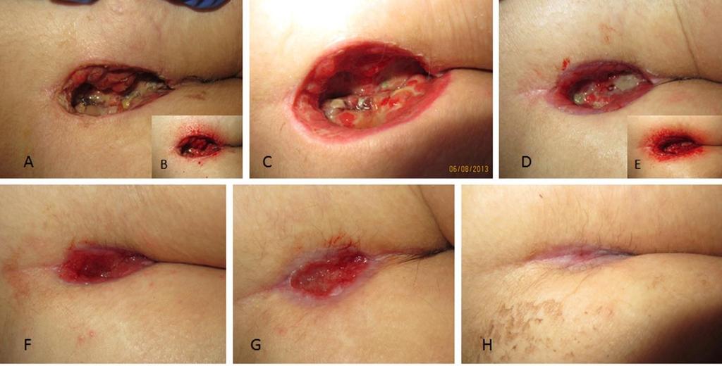 Results Case 1: 24-year old female patient with a painful abscessing pilonidal sinus Surgical excision of the complete pilonidal cyst without plastic covering Wound treatment according to wound care