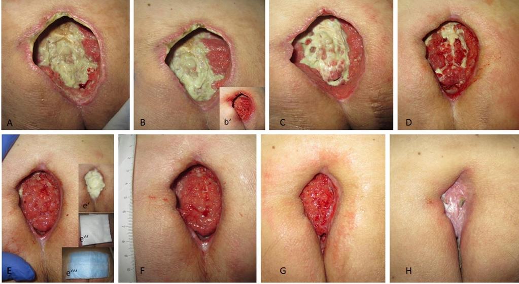 Second to fourth week twice a week wound treatment without mechanical debridement (C,D) o Alginate tamponade was applied to avoid superficial wound closure and wound infection.