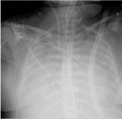 Assessment and Plan Likely community acquired pneumonia with sepsis Ceftriaxone and azithromycin Add sulfamethoxazole/trimethoprim due to steroid use and possible pneumocystis jiroveci pneumonia