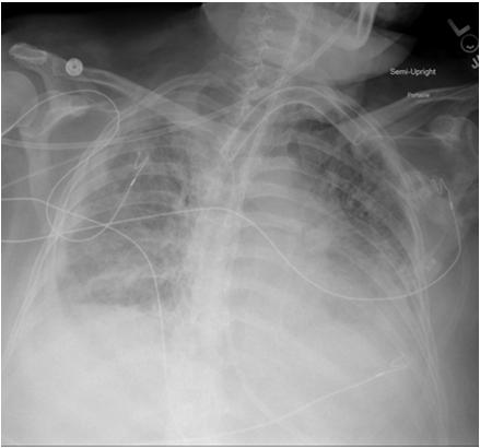 Post ECLS Day 8 Bilateral infiltrates R > L Bilateral effusions No pneumothorax Post ECLS Course Day 9-14 ECMO restart not considered Family wished to continue all other aggressive cares Slow