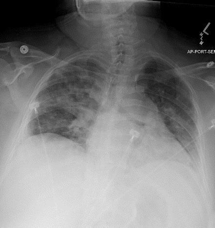 ADMISSION CXR Bilateral infiltrates Right greater than