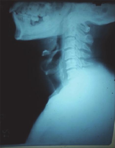 The thyroid and cricoid cartilages, hypopharynx, larynx, and trachea were displaced to the left without obvious evidence of erosion or infiltration.