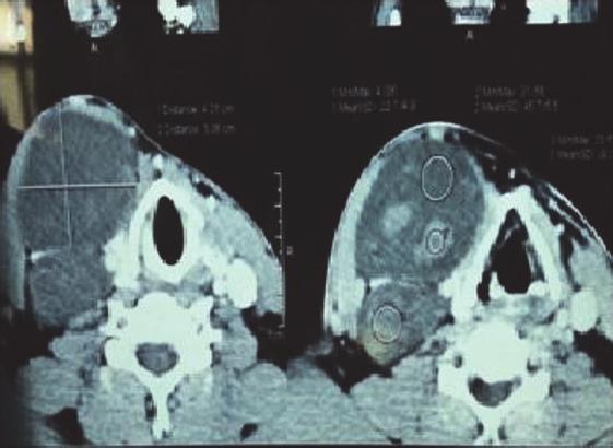 FNAC result revealed a benign colloid nodule. As malignancy was ruled out, no further action was taken on the thyroidgland.theswellinginquestionwasnotevidentonthe scintigraphy (Figure 4).