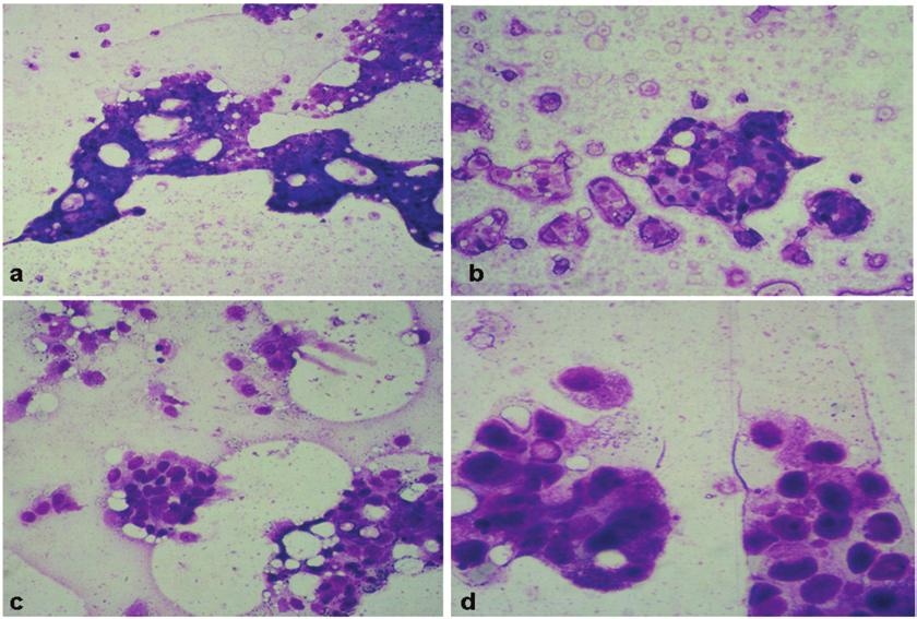 Malaysian J Pathol June 2008 FIG. 1: a and b. Cribriform and acinar clusters in FNA cytology. MGG, X200; c.
