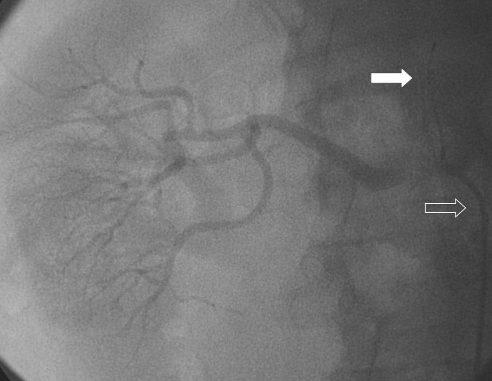 CLINICAL REVIEW Technical Considerations for Renal Artery Stenting Jeffrey A.