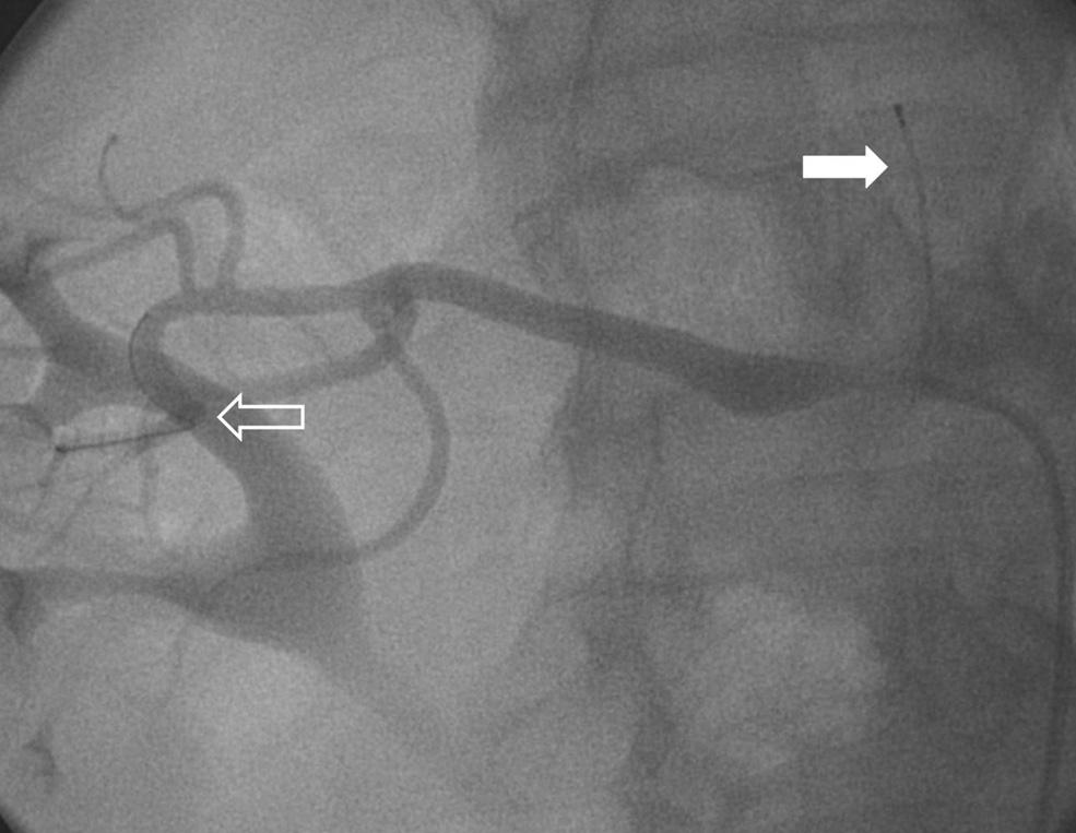 Goldstein, et al. failed angioplasty (ASPIRE-2), aspirin 81 500 mg was administered at least one day prior to the procedure and at the operator s discretion post-procedurally.