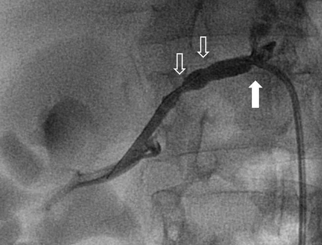 TECHNICAL CONSIDERATIONS FOR RENAL ARTERY STENTING stent with the ostium uncovered may contribute to restenosis or even stent embolization (Figure 4).