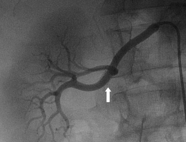 Once this is achieved, the guide catheter can be advanced over the deflating balloon within the lumen of the stent for final angiography.