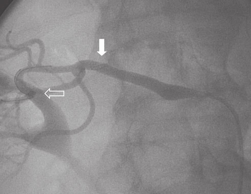 Goldstein, et al. Restenosis Restenosis with RAS is approximately 40% for arteries less than 4 mm in diameter, 14 18% for arteries 5.5 mm, and less than 10% for arteries greater than 6 mm in diameter.