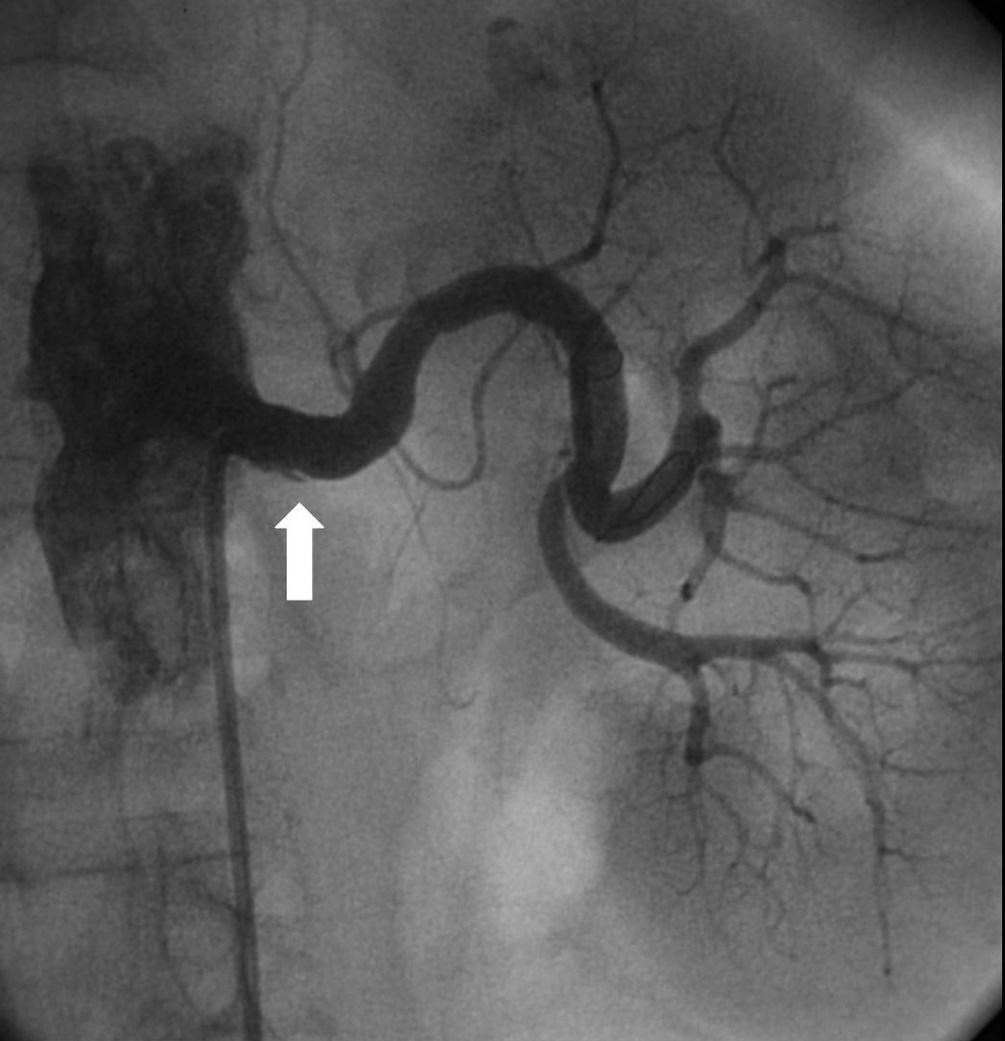 TECHNICAL CONSIDERATIONS FOR RENAL ARTERY STENTING the stent of 225 cm/sec was felt to represent 60% restenosis.