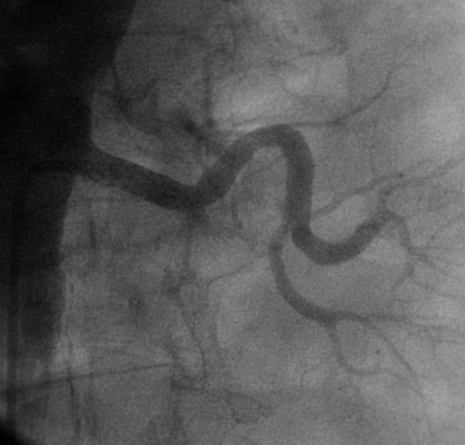 7 The incidental finding of renal artery in-stent restenosis in a patient with stable renal function and controlled hypertension poses a difficult therapeutic dilemma.