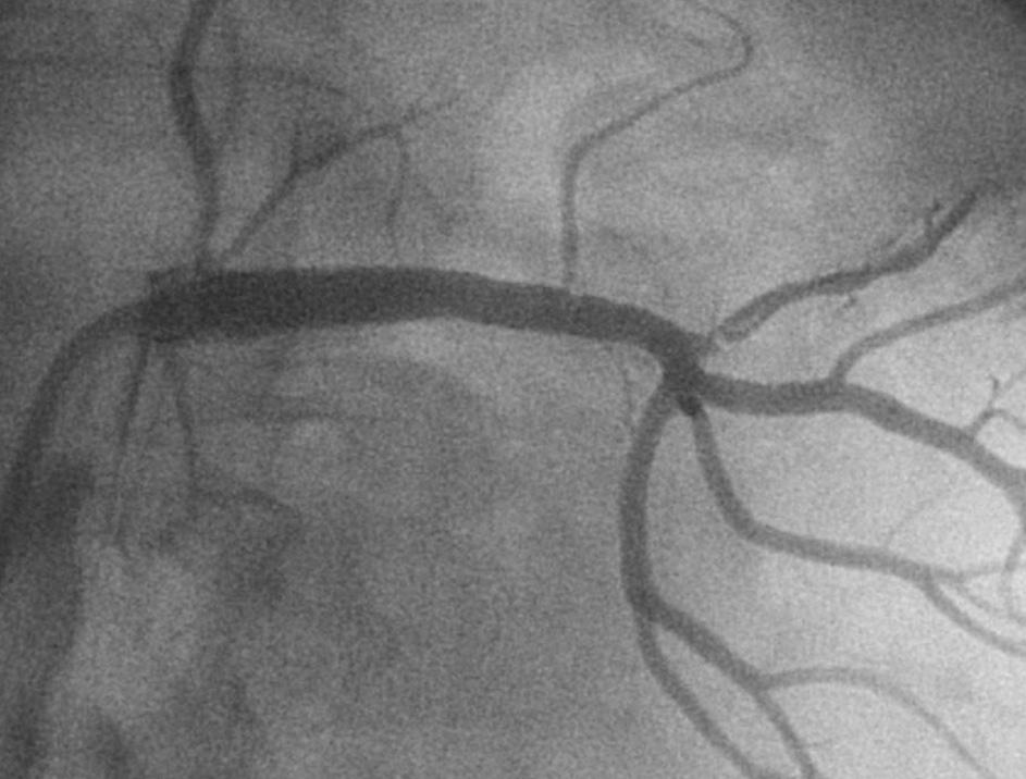 Percutaneous transluminal renal angioplasty versus surgical reconstruction of atherosclerotic renal artery stenosis: A prospective randomized study. J Vasc Surg 1993;18:841 850; discussion 850 852. 4.