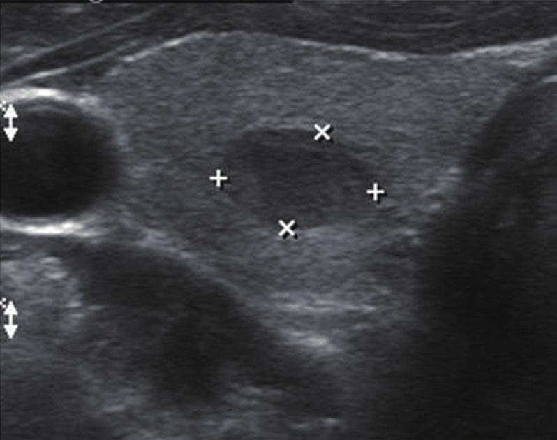 Kim GY, et al. CSE REPORT 34-year-old man presented at our hospital for the surgical management of an incidental thyroid nodule that was observed on an ultrasound sonography (USG) of the neck.