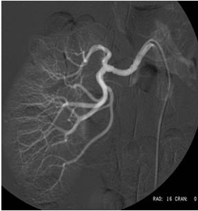 Renal artery stenosis Know the clinical clues to its presence Recognize the association with ischemic cardiovascular disease Recognize that patients may have