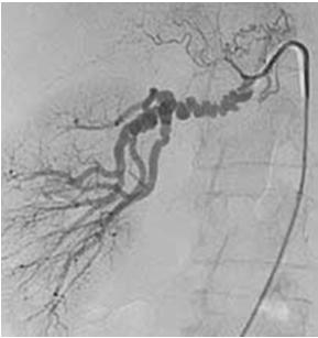 Medial Hyperplasia Adventitial Fibroplasia Mayo Clin Proc 1971;46:161 US FMD Registry Atherosclerosis