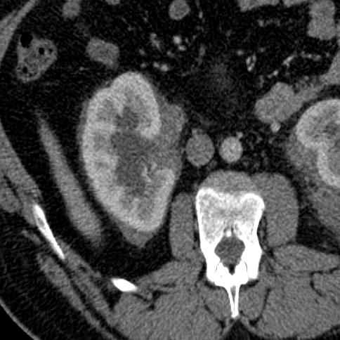 CT/MRI evaluation: peri-renal
