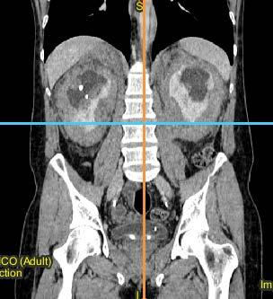 CT/MRI evaluation: peri-ureteral involvement