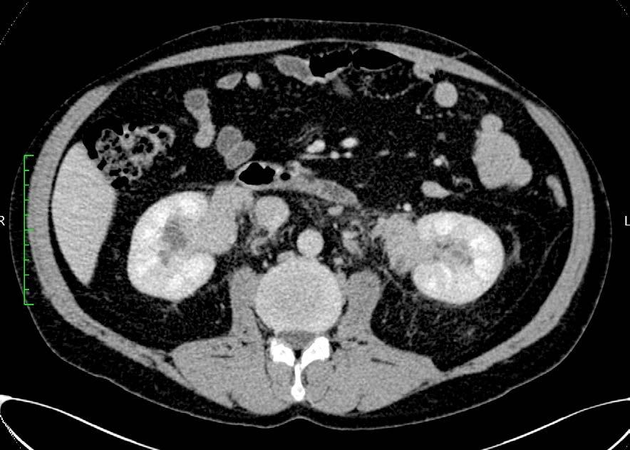 CT/MRI evaluation: peri-ureteral involvement Cases with isolated