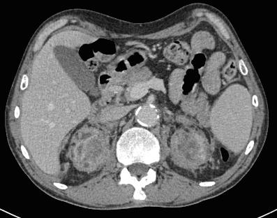 CT/MRI evaluation: renal atrophy Renal