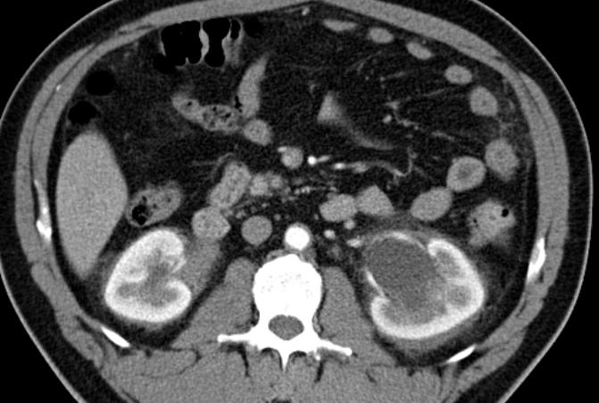 CT/MRI evaluation: peri-renal involvement Peri-renal infiltration was detected in 22 patients (71%) 11/15 tested (73%) BRAF V600E In almost all cases it extended to