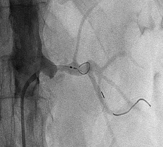 2 84-year-old man with worsening renal insufficiency, hypertension, and marked ostial renal artery stenosis. Angiogram shows FilterWire (Boston Scientific) device. Fig.