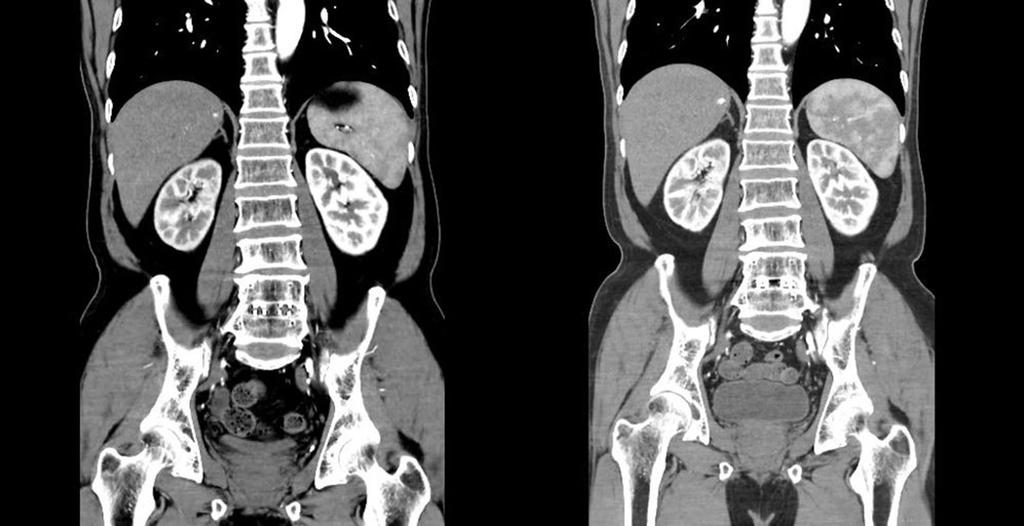 P; antero-posterior, CR; cranial, LO; left anterior oblique Fig. 2. bdominal angiography before () and after () placement of the renal artery stent utilized to perform the endovascular treatment.