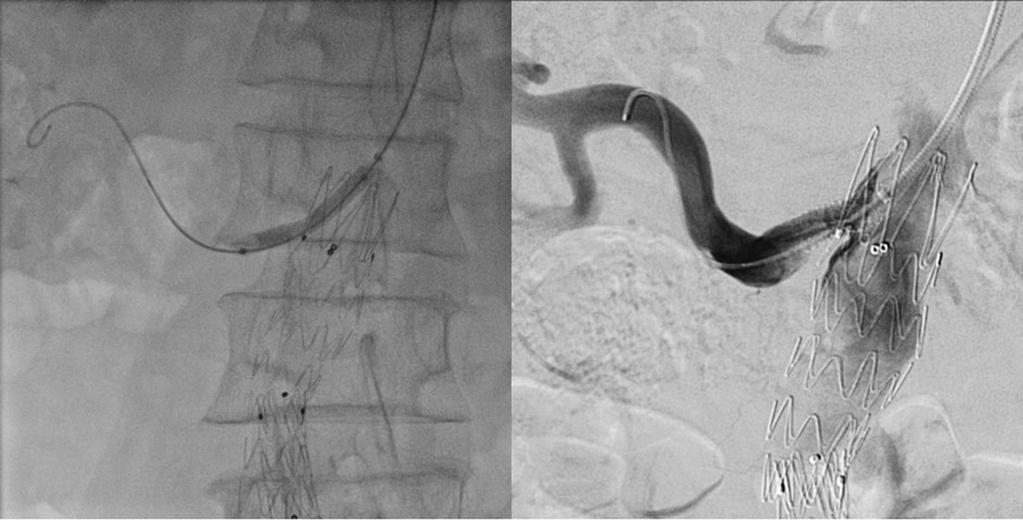 alloon angioplasty using a 5 40 mm balloon () and final angiogram () after deployment of 6 18 mm SCU stent right femoral approach.
