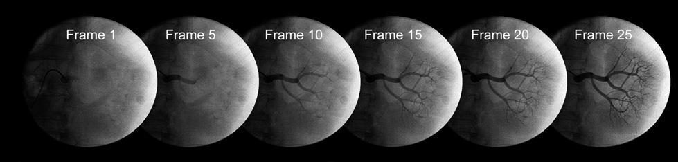 Renal frame count Still frame images obtained at 30 frames/s. First frame is counted with complete transverse opacification of the renal artery.