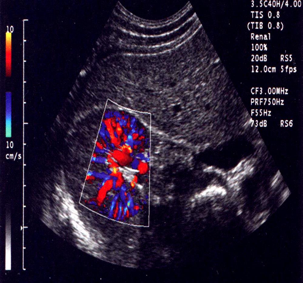 Renal Artery Duplex ultrasound - AT Normal Doppler-signal