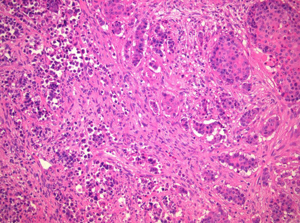 The various possible components GI tract Adenoma/adenocarcinoma Squamous Neuroendocrine neoplasm Poorly differentiated Well differentiated Pancreas