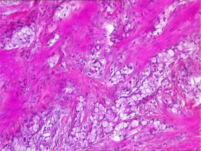Mixed tumours: morphology GOBLET CELL