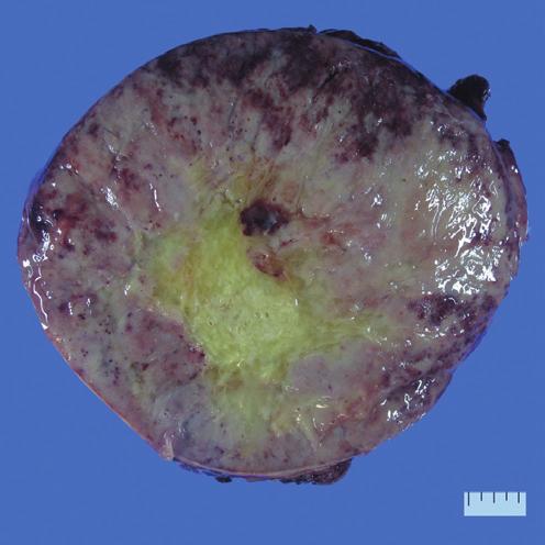 224 Ahn S, et al. A B C D E F G H Fig. 1. Atypical carcinoid presents as a soft, white-tan to brown mass (A).