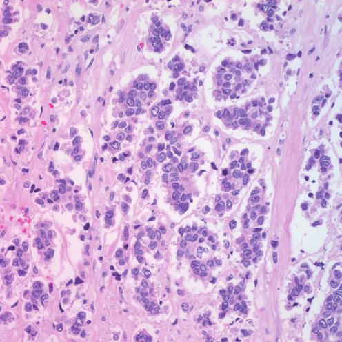 Furthermore, there was another patient with ectopic hormone secretion who developed a pulmonary metastasis.