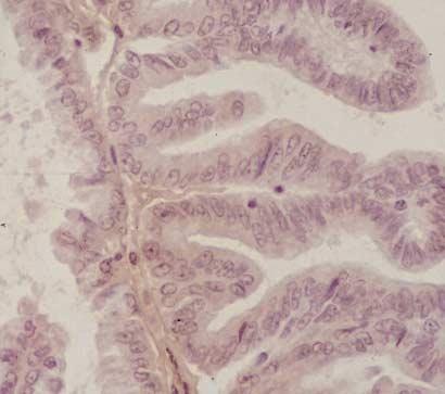 MSI, MMR in Intrahepatic Cholangiocarcinoma 11 A B C D Fig. 2.