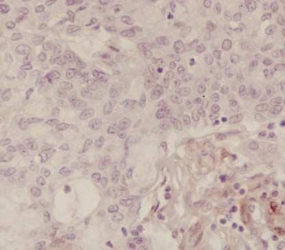 carcinoma, and preserved hmsh2 in intraductal (C) and invasive (D) carcinoma component. (Fig. 2 continued next) er 18 markers.