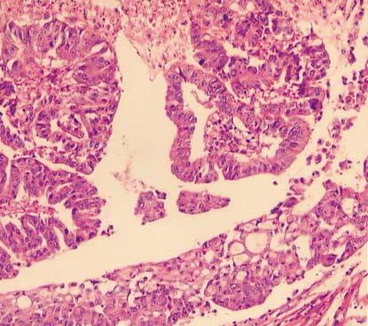 invasive adenosquamous carcinoma component (G, H) with area of gradual transition (F). tumors.