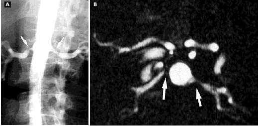 Angiography and magnetic resonance angiography From UpToDate