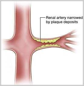Renal artery intervention