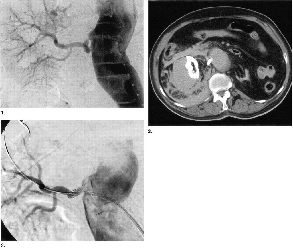 Renal artery intervention is not risk-free Fatal bleed after perforation with
