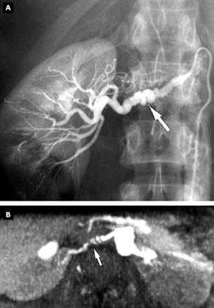 Fibromuscular dysplasia (FMD) inborn error of vascular structure usually younger female patients with positive family history
