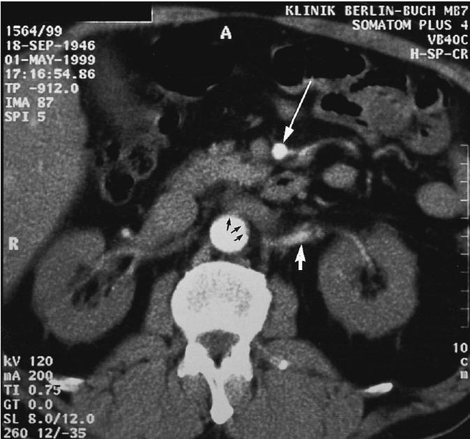 Obstruction of the renal arteries due to aortic dissection rarely the leading symptom of aortic dissection often found on