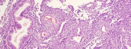 Endometrial Stromal Tumors DDx: polyp,