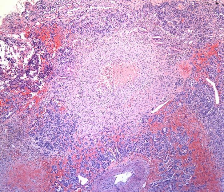 Atypical Carcinoid Tumor Patterns Organoid