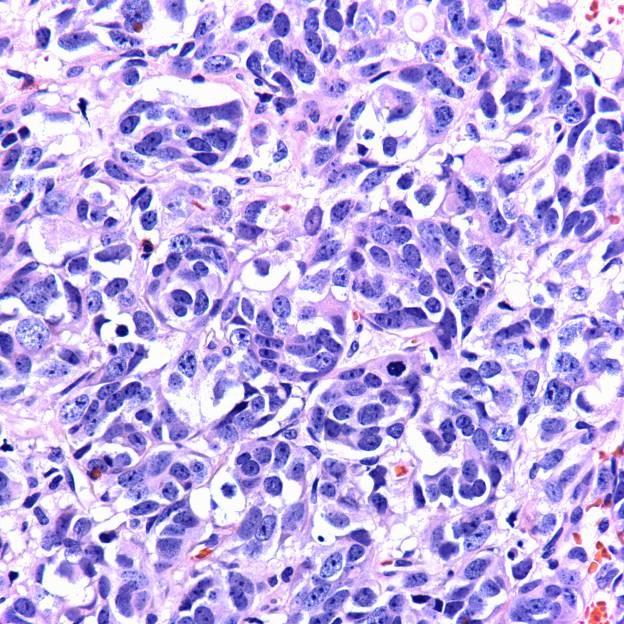 Atypical Carcinoid Tumor Pleomorphism Rosettes, acinar structures, palisading Oval, round, spindle, plasmacytoid cells Larger than